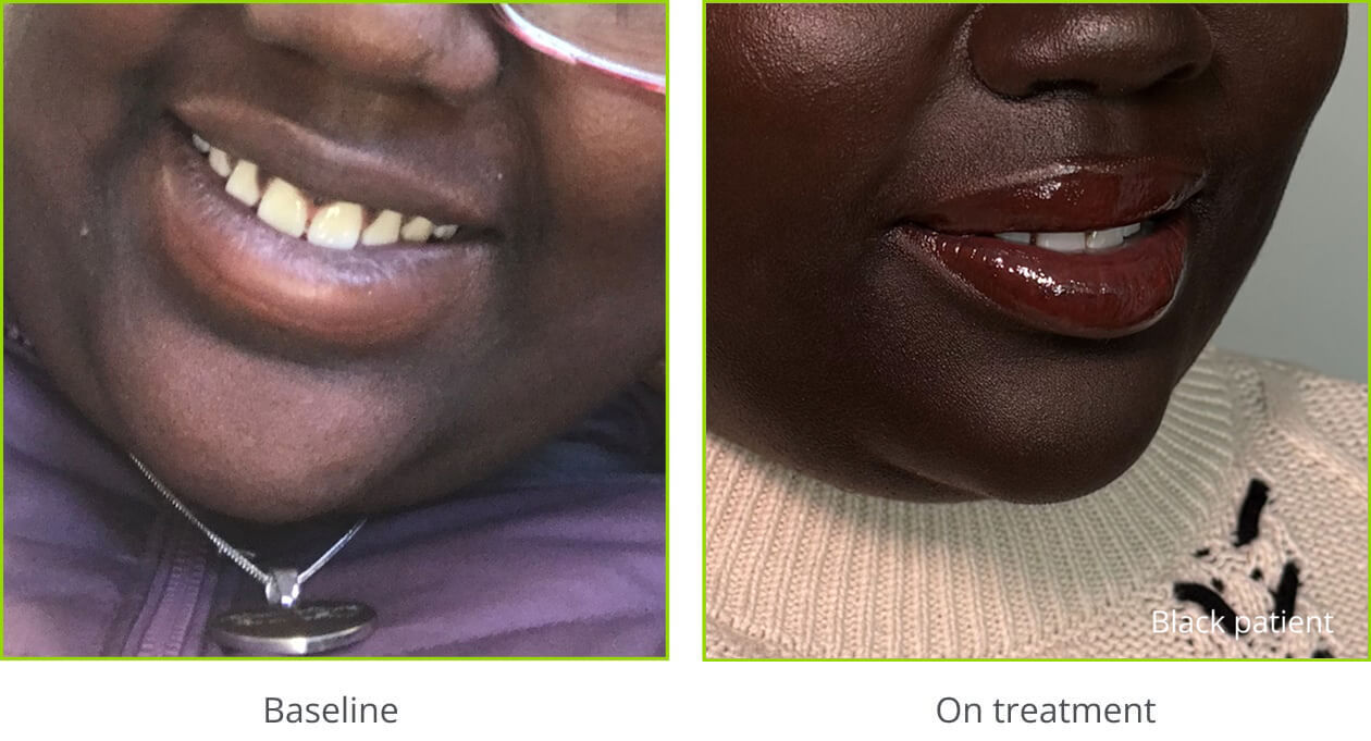 Example of hyperpigmentation